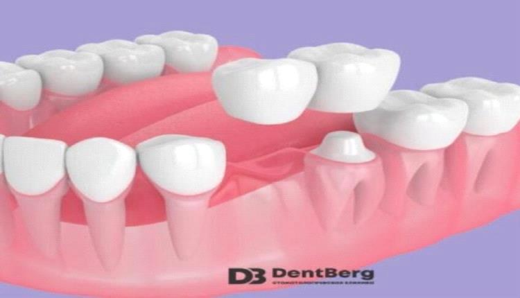اكتشاف روسي يطور زراعة الأسنان ويقلل التكلفة والوقت للنابذين للعمليات الجراحية