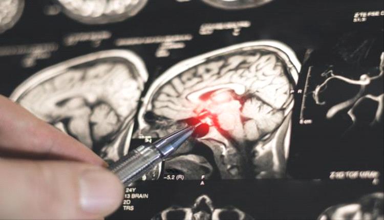 اكتشاف روسي يفتح الباب لعلاج باركنسون عبر بروتين CRYAB