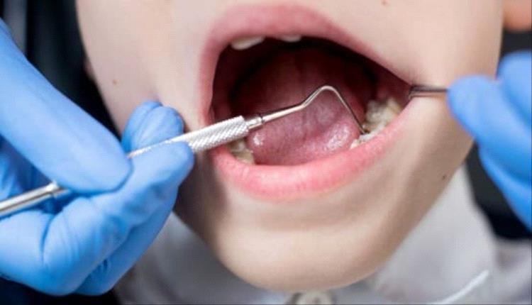 سائل طبي يوقف تسوس الأسنان لدى الأطفال دون حفر أو تخدير
