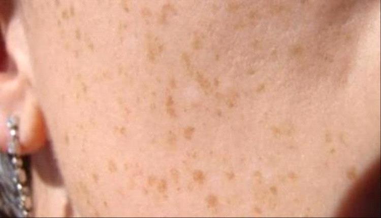 ما الأسباب الرئيسية لظهور بقع وتغيرات في لون الجلد؟