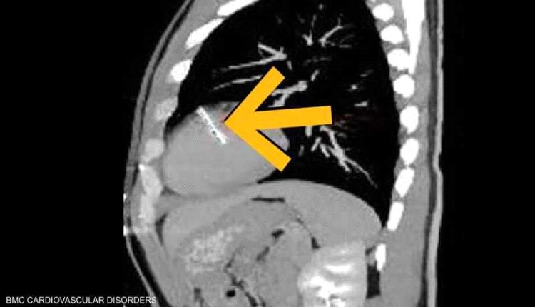 إبرة خياطة داخل قلب رجل.. حالة نادرة تكشفها الفحوص الطبية