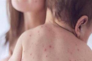 بنجلادش تواجه أسوأ تفشٍ للحصبة مع تراجع معدلات التطعيم