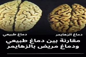 ألزهايمر.. التشخيص المبكر والتقنيات الحديثة تفتحان آفاقاً جديدة للتعامل مع المرض