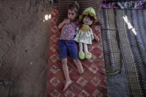 غزة تسجل آلاف حالات البتر وسط أزمة حادة في خدمات التأهيل